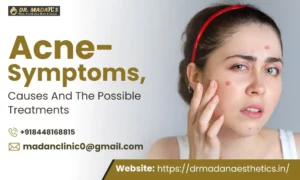 Read more about the article Acne – Symptoms, Causes And The Possible Treatments