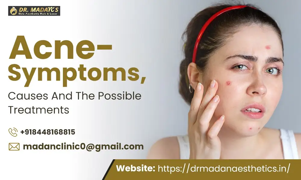 You are currently viewing Acne- Symptoms, Causes And The Possible Treatments