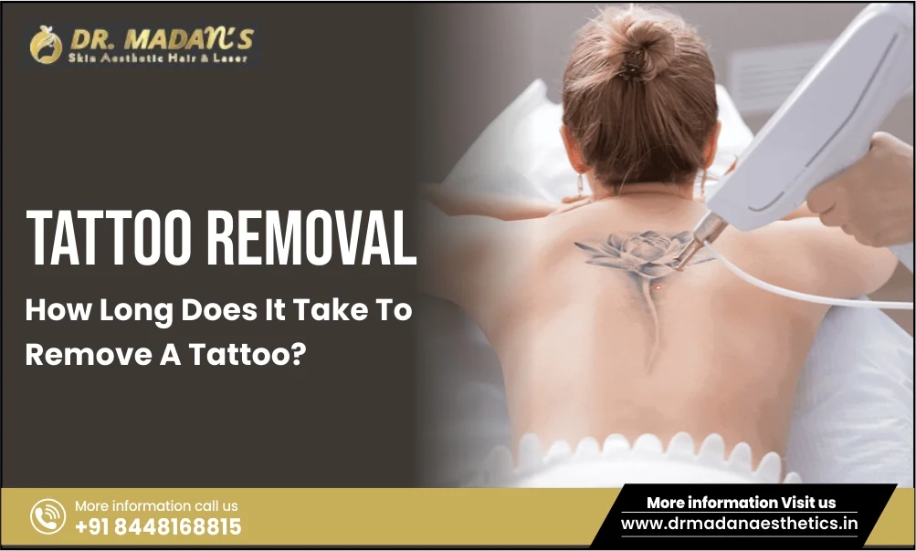 Read more about the article Tattoo Removal – How Long Does It Take To Remove A Tattoo?