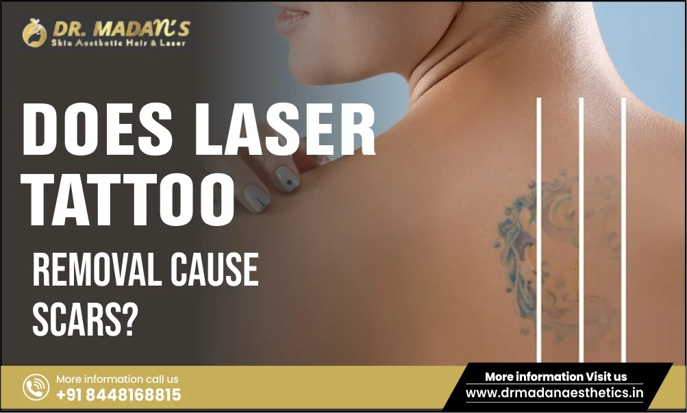 You are currently viewing Does Laser Tattoo Removal Cause Scars?