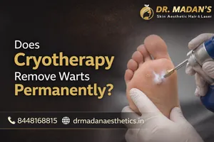 Read more about the article Does cryotherapy remove warts permanently?