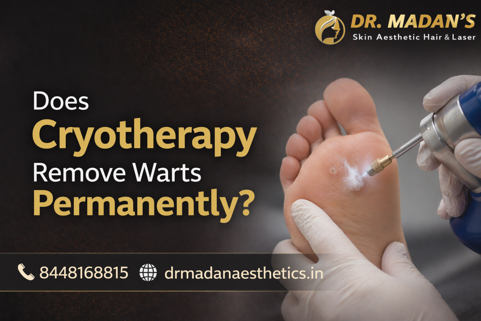 You are currently viewing Does cryotherapy remove warts permanently?