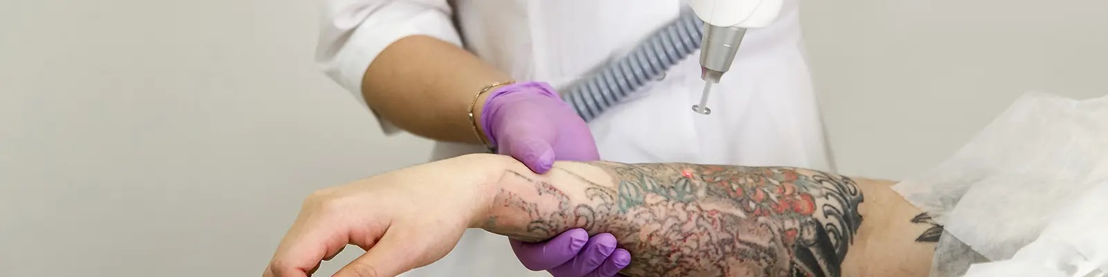  Tattoo Removal In Delhi