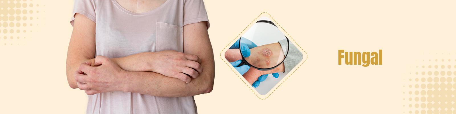  Fungal Infection Treatment In Delhi