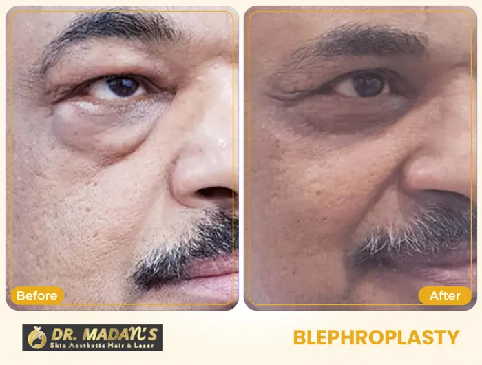 Blephroplasty before and after result 1 at Dr Madan Aesthetics