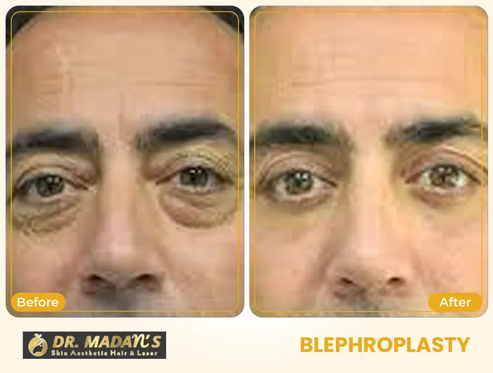 Blephroplasty before and after result 2 at Dr Madan Aesthetics