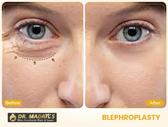 Blephroplasty before and after result 3 at Dr Madan Aesthetics