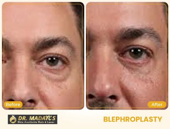 Blephroplasty before and after result 4 at Dr Madan Aesthetics