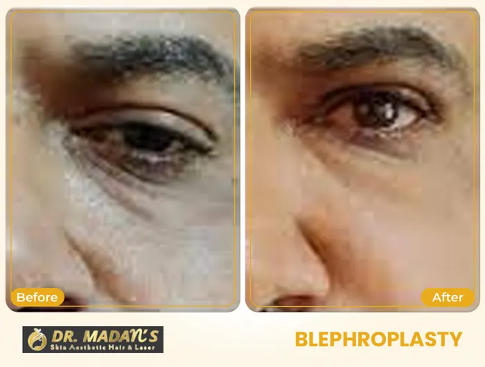 Blephroplasty before and after result 5 at Dr Madan Aesthetics