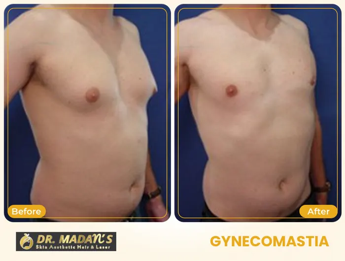 Gynecomastia before and after result 1 at Dr Madan Aesthetics