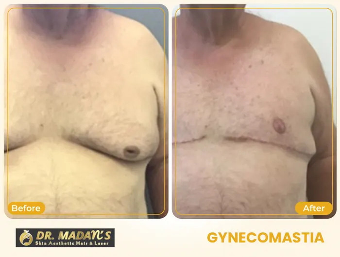 Gynecomastia before and after result 2 at Dr Madan Aesthetics