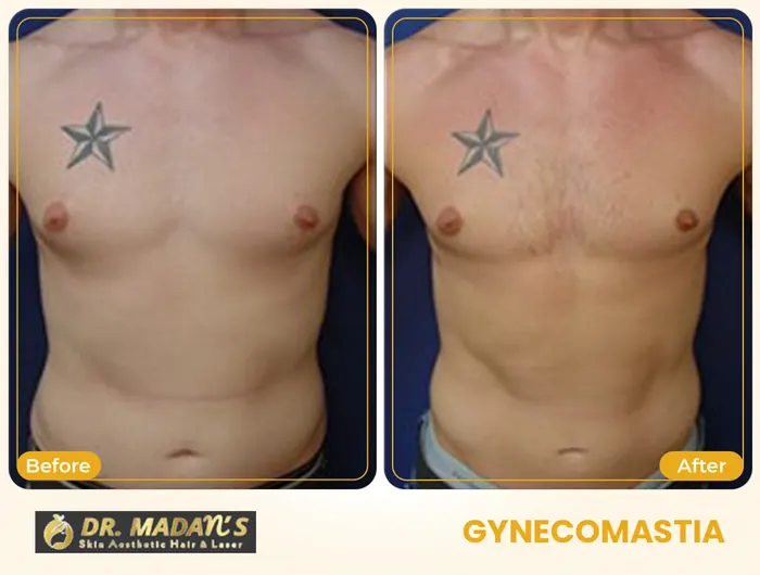 Gynecomastia before and after result 3 at Dr Madan Aesthetics