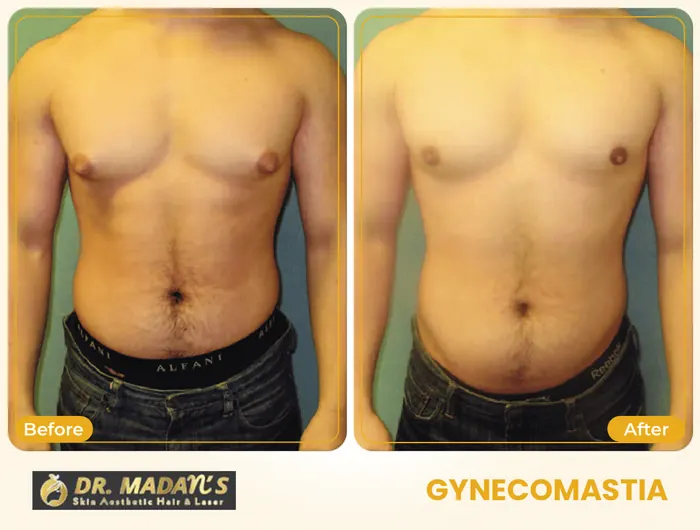 Gynecomastia before and after result 4 at Dr Madan Aesthetics