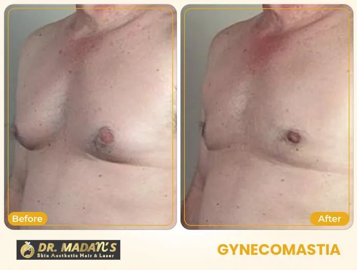 Gynecomastia before and after result 5 at Dr Madan Aesthetics