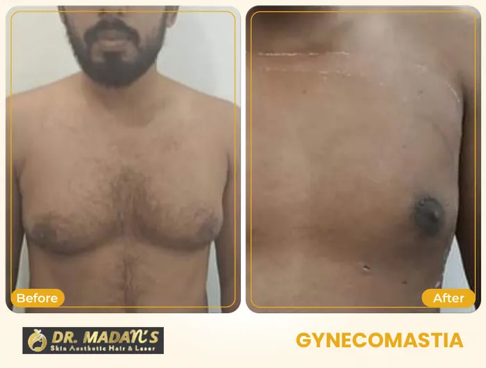 Gynecomastia before and after result 6 at Dr Madan Aesthetics
