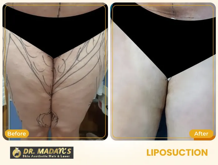 Liposuction before and after result 1 at Dr Madan Aesthetics