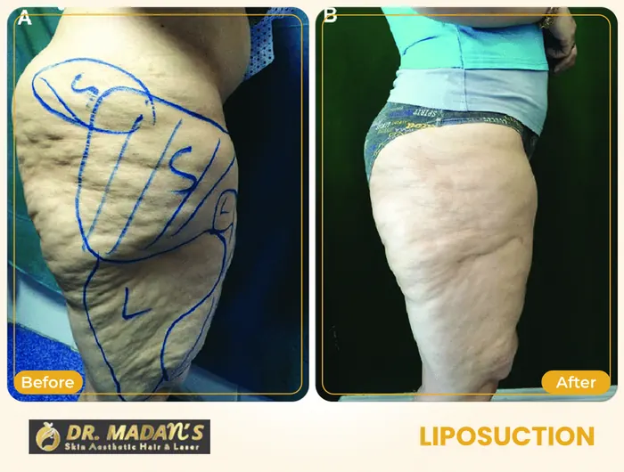Liposuction before and after result 2 at Dr Madan Aesthetics