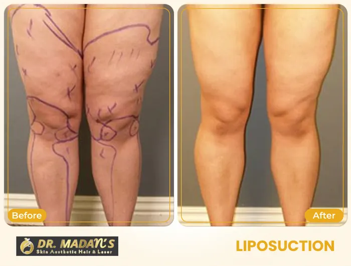 Liposuction before and after result 3 at Dr Madan Aesthetics