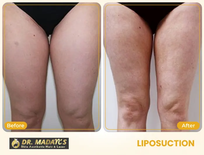 Liposuction before and after result 4 at Dr Madan Aesthetics