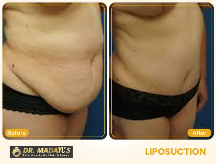 Liposuction before and after result 5 at Dr Madan Aesthetics