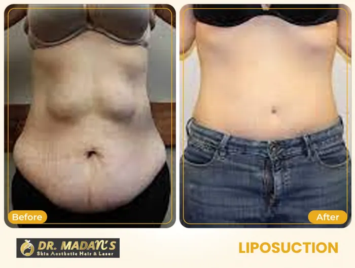 Liposuction before and after result 6 at Dr Madan Aesthetics