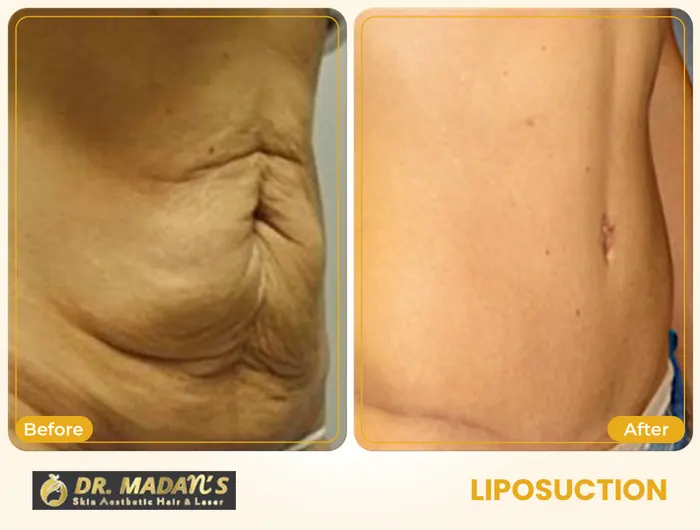 Liposuction before and after result 7 at Dr Madan Aesthetics