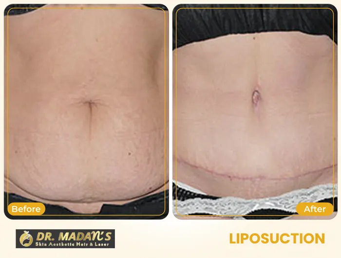 Liposuction before and after result 8 at Dr Madan Aesthetics