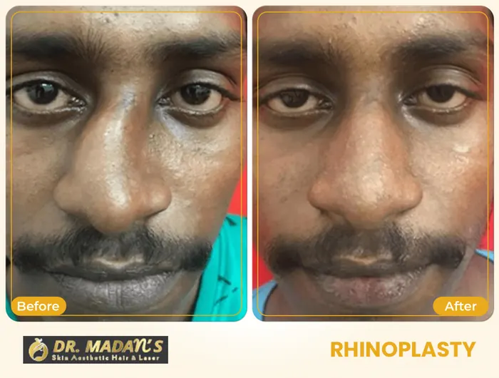 Rhinoplasty before and after result 1 at Dr Madan Aesthetics