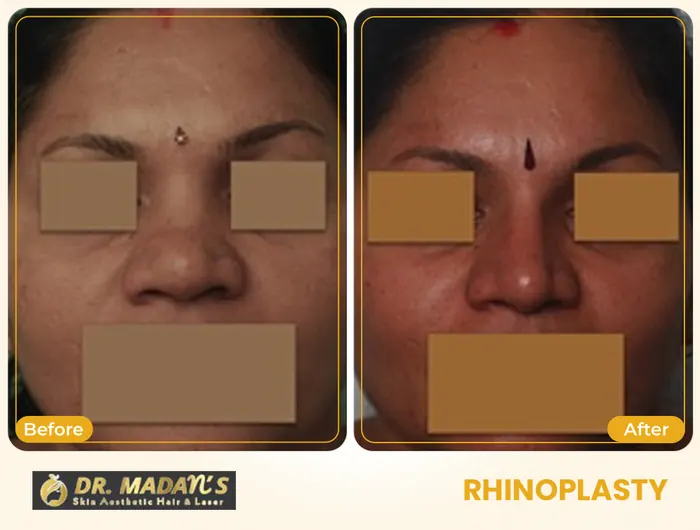 Rhinoplasty before and after result 2 at Dr Madan Aesthetics