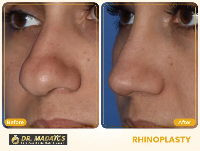 Rhinoplasty before and after result 3 at Dr Madan Aesthetics