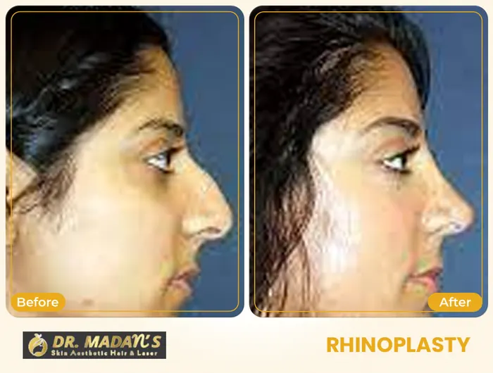 Rhinoplasty before and after result 5 at Dr Madan Aesthetics