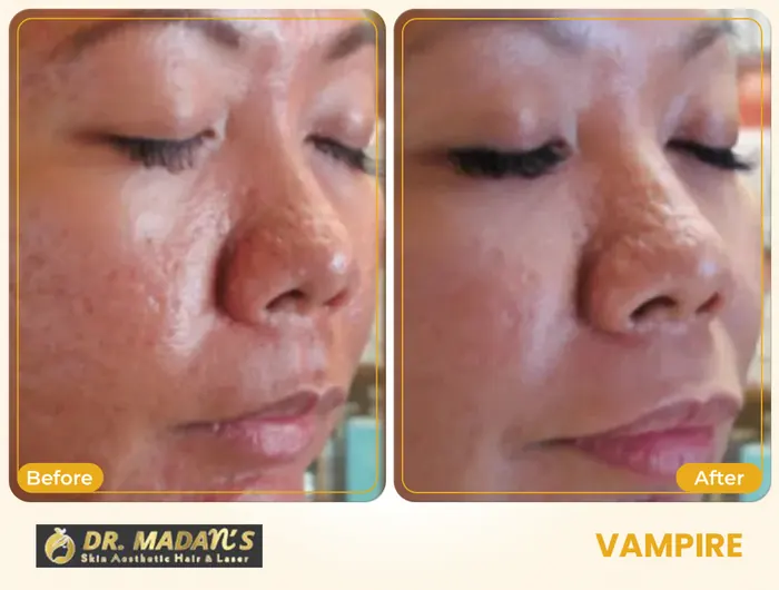 Vampire before and after result at Dr Madan Aesthetics
