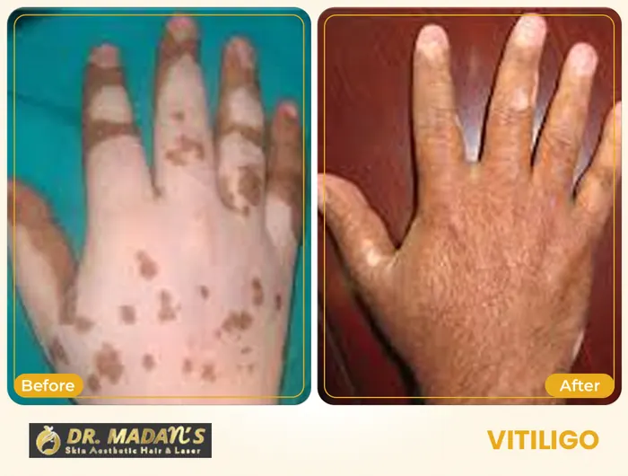 Vitiligo before and after result 1 at Dr Madan Aesthetics