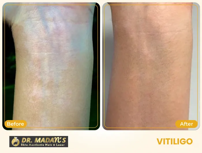 Vitiligo before and after result 2 at Dr Madan Aesthetics