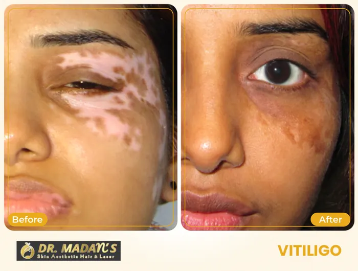 Vitiligo before and after result 3 at Dr Madan Aesthetics
