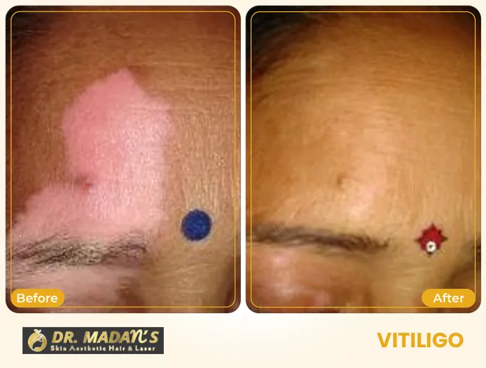 Vitiligo before and after result 4 at Dr Madan Aesthetics