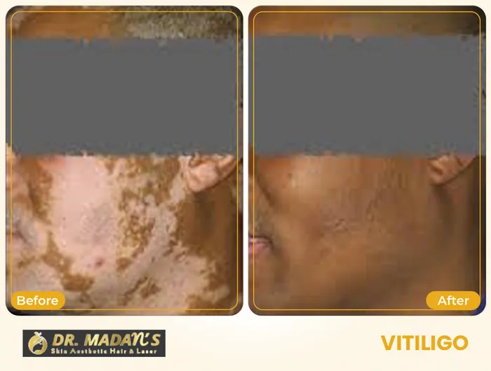 Vitiligo before and after result 5 at Dr Madan Aesthetics