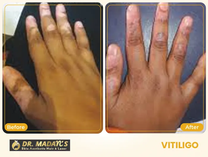 Vitiligo before and after result 6 at Dr Madan Aesthetics