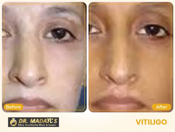Vitiligo before and after result 7 at Dr Madan Aesthetics